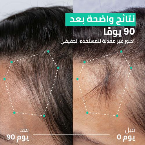 روتين مزدوج الفعالية لتكثيف الشعر - حل لتساقط الشعر في 90 يوم image number null